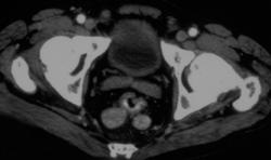 Splenosis in the Pelvis - CTisus CT Scan