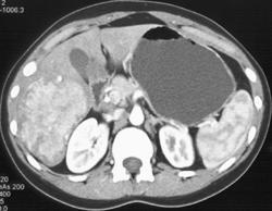 Normal Spleen in Arterial Phase - CTisus CT Scan