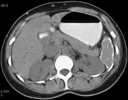 Sickle Cell Disease - CTisus CT Scan