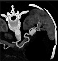 Splenic Artery Aneurysm - CTisus CT Scan