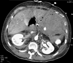 Splenic Artery Pseudoaneurysm With Bleed - CTisus CT Scan