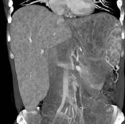Sarcoidosis - CTisus CT Scan