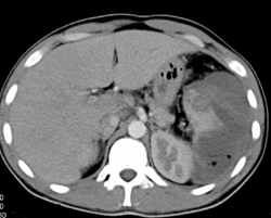 Splenic Abscess - CTisus CT Scan
