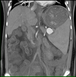 Splenic Artery Aneurysm - CTisus CT Scan