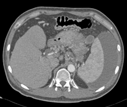 Perisplenic Fluid - CTisus CT Scan