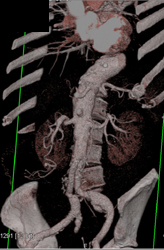Splenic Artery Aneurysm - CTisus CT Scan