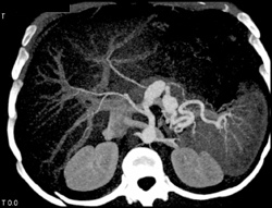 Splenic Artery Aneurysm - CTisus CT Scan