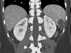 Splenic Cyst - CTisus CT Scan