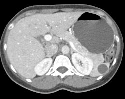 Splenic Cyst - CTisus CT Scan