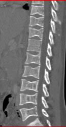 Sickle Cell Disease- Spleen and Bone - CTisus CT Scan