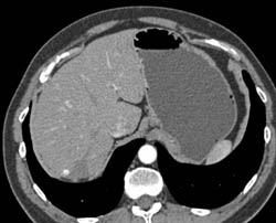 Splenic Hemangioma - CTisus CT Scan