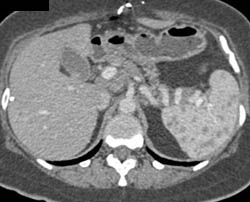 Sarcoidosis - CTisus CT Scan