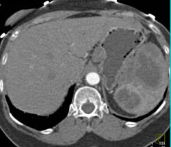 Splenic Lymphoma With Nodes - CTisus CT Scan