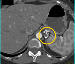 Splenic Artery Aneurysm - CTisus CT Scan