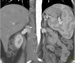 Splenic Artery Aneurysm - CTisus CT Scan