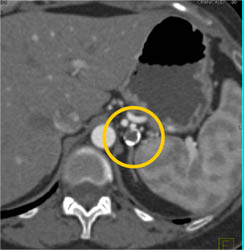 Splenic Artery Aneurysm - CTisus CT Scan