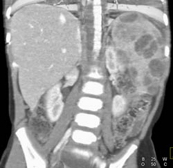 Splenic Hemangiomas - CTisus CT Scan