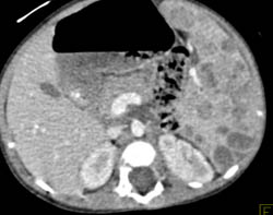 Splenic Hemangiomas - CTisus CT Scan