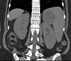 Splenic Cyst - CTisus CT Scan