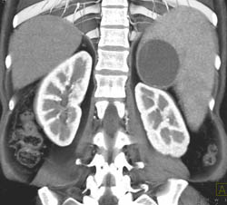Splenic Cyst - CTisus CT Scan