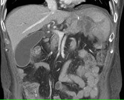 Splenic Abscess - CTisus CT Scan