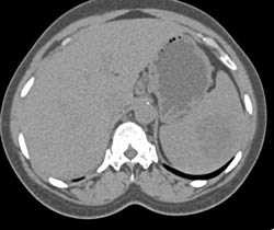 Lymphoma With Celiac Nodes - CTisus CT Scan