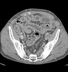 Splenomegaly Due to Portal Hypertension With Varices - CTisus CT Scan