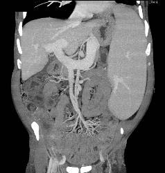 Splenomegaly Due to Portal Hypertension With Varices - CTisus CT Scan