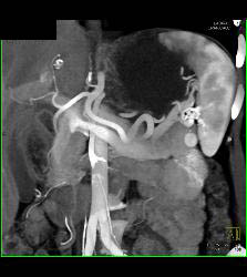 Splenule in Splenic Hilum - CTisus CT Scan