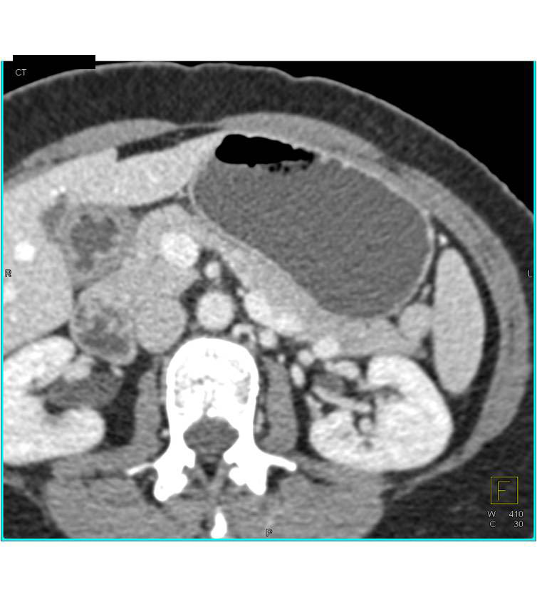 Splenule near Tail of Pancreas - CTisus CT Scan