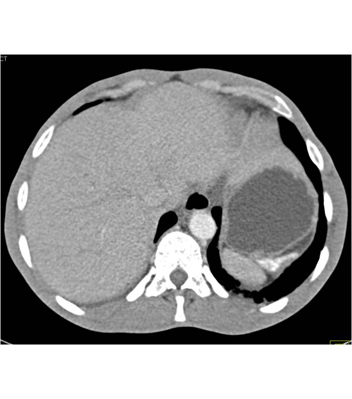 Sickle Cell Disease with Auto infarcted Spleen and Gallstones - CTisus CT Scan