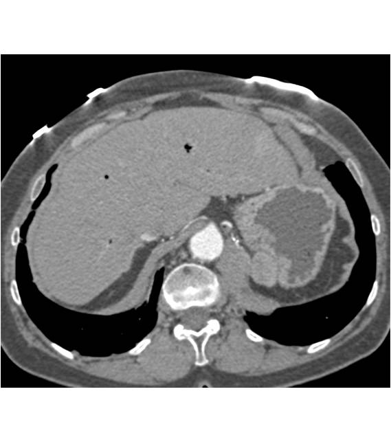 Splenosis Simulates Tumor Recurrence - CTisus CT Scan