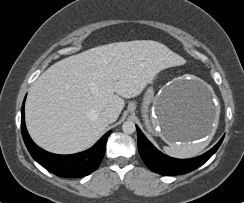 Calcified Splenic Cyst - CTisus CT Scan