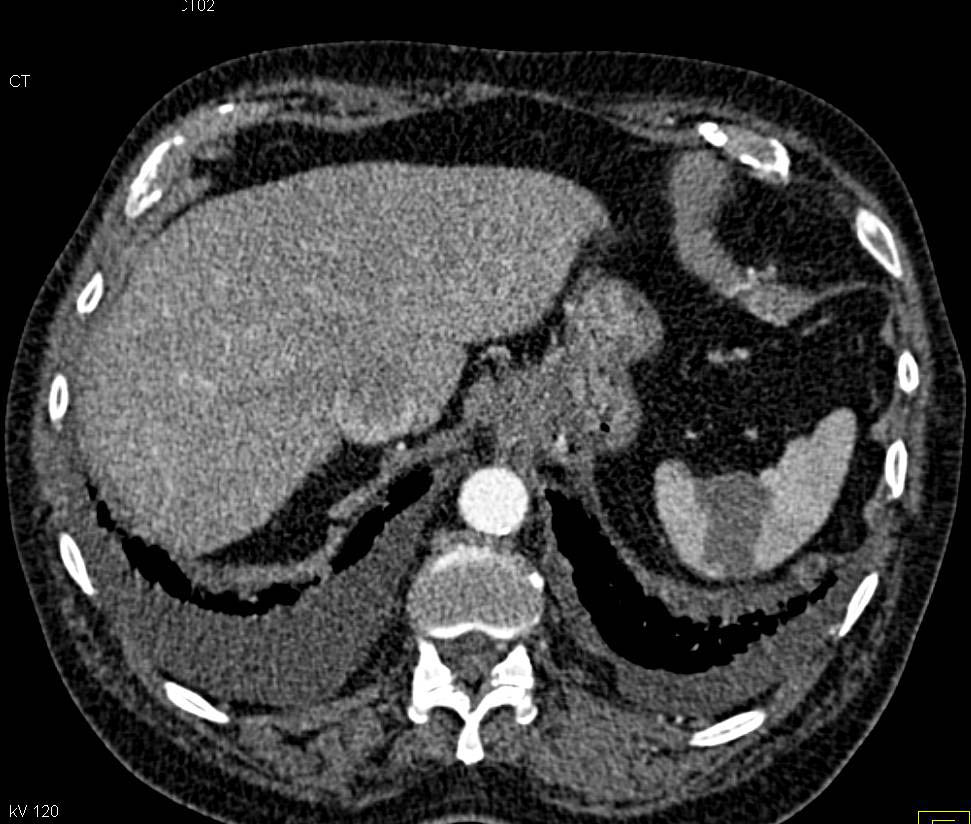 Splenic Infarct - CTisus CT Scan