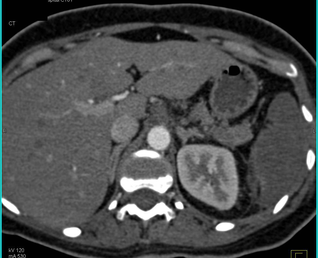 Splenic and Renal Infarcts as Well as Bone Infiltration by Tumor. All Shown in Multiple 3D Images - CTisus CT Scan