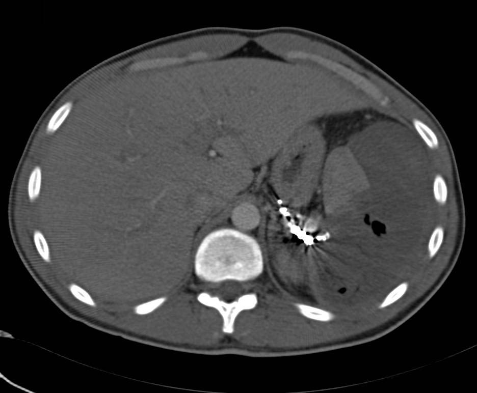 Splenic Infarct s/p Embolization - CTisus CT Scan