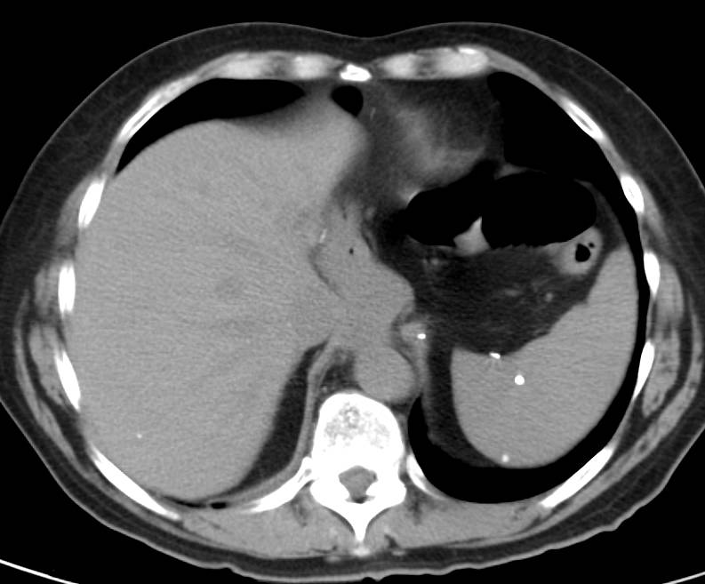 Splenic Sarcoidosis - CTisus CT Scan