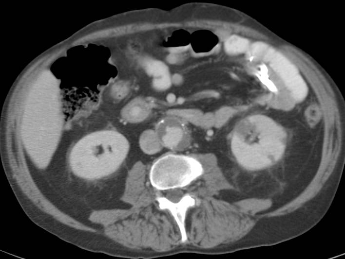 Multiple Segmental Splenic and Left Renal Infarcts - CTisus CT Scan