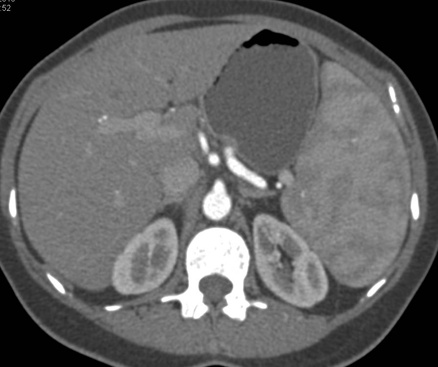 Splenomegaly with Splenic Artery Aneurysm in a Patient with Polycythemia Vera - CTisus CT Scan