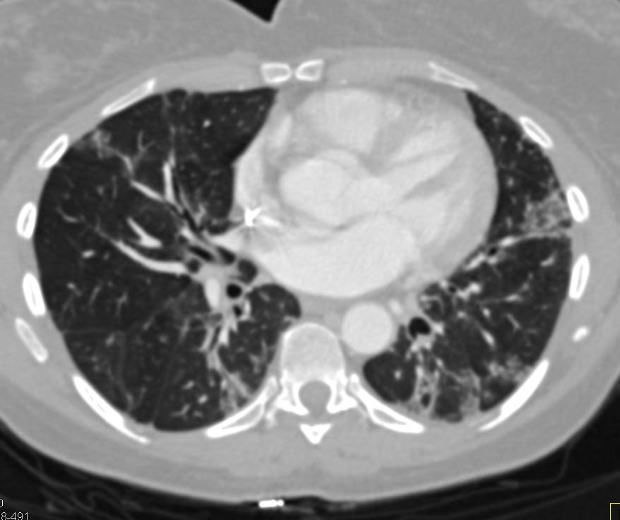 Patient with Colon Cancer and Evidence of Embolism in Kidney, Liver, Spleen and Lung - CTisus CT Scan