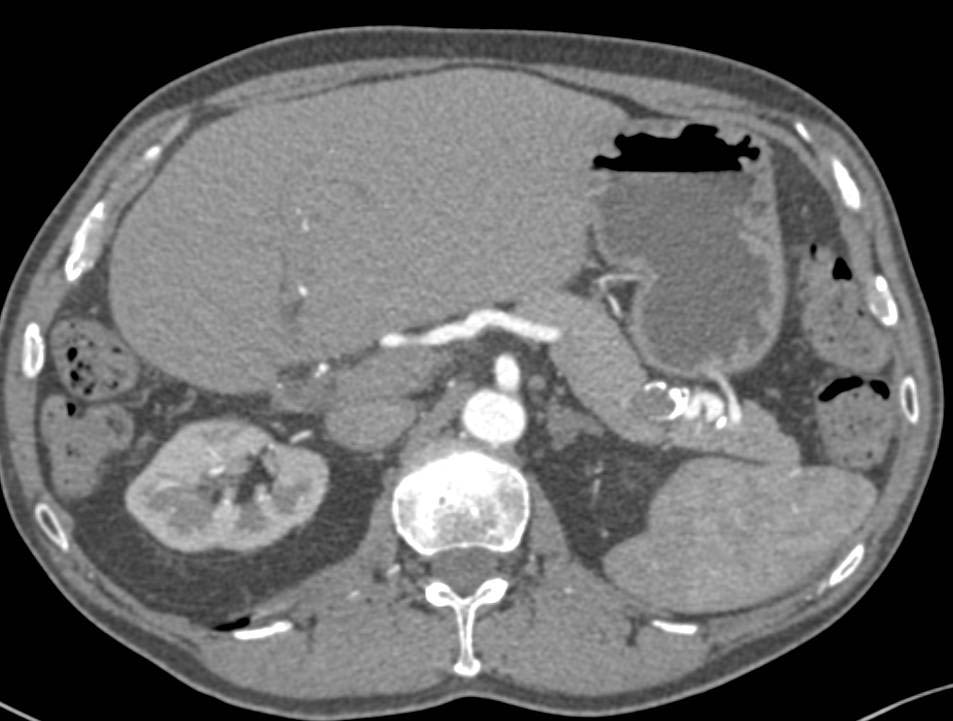 Splenic Artery Aneurysm - CTisus CT Scan