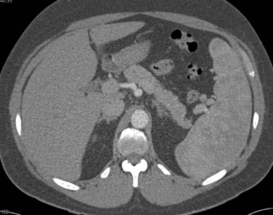 Myelofibrosis with Sclerotic Bone Lesions and Splenomegaly - CTisus CT Scan