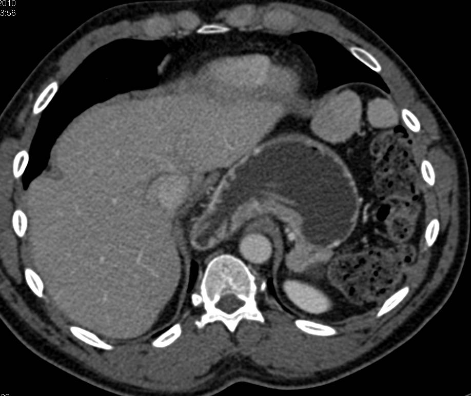 Splenosis due to Prior Trauma - CTisus CT Scan