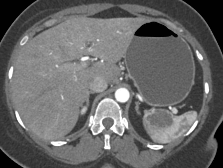 Splenic Hemangioma - CTisus CT Scan