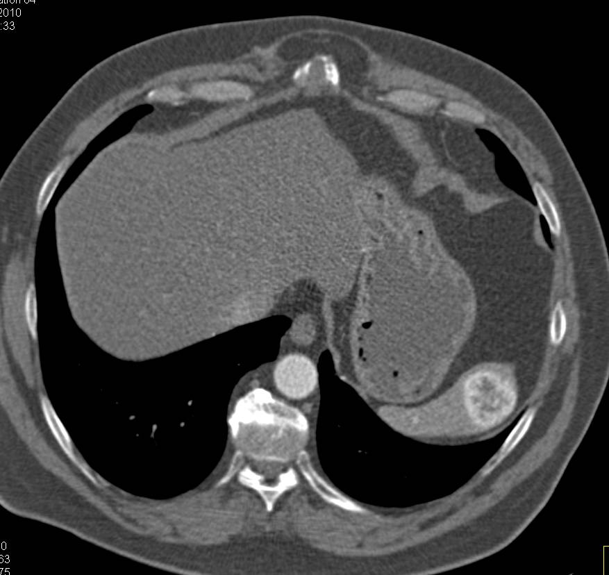 Renal Cell Carcinoma Metastatic to the Spleen with Vascular Metastases - CTisus CT Scan