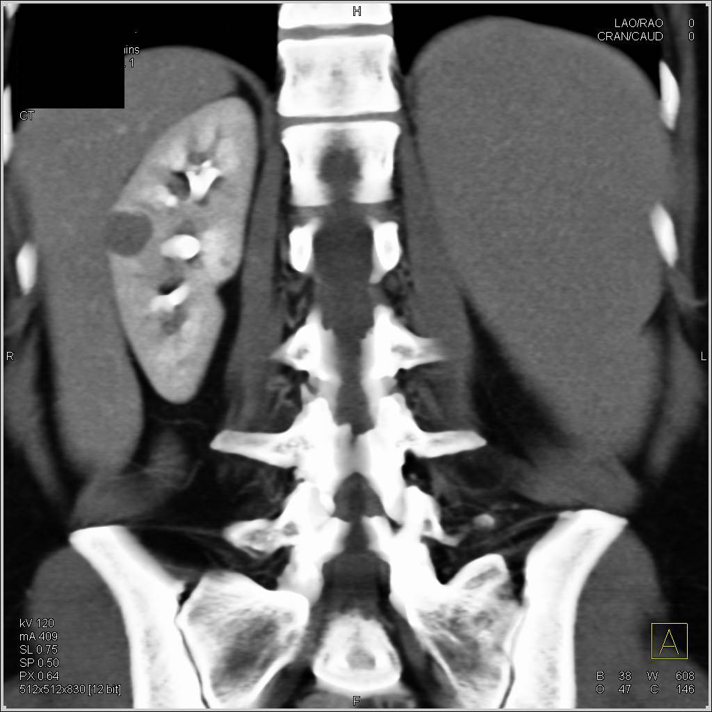 Lymphoma Infiltrates the Spleen - CTisus CT Scan