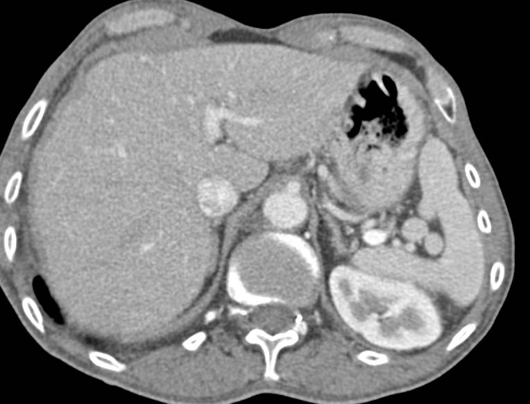 Splenules - CTisus CT Scan
