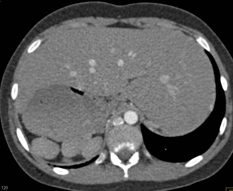 Situs Inversus with Polysplenia: Great Example of Polysplenia - CTisus CT Scan