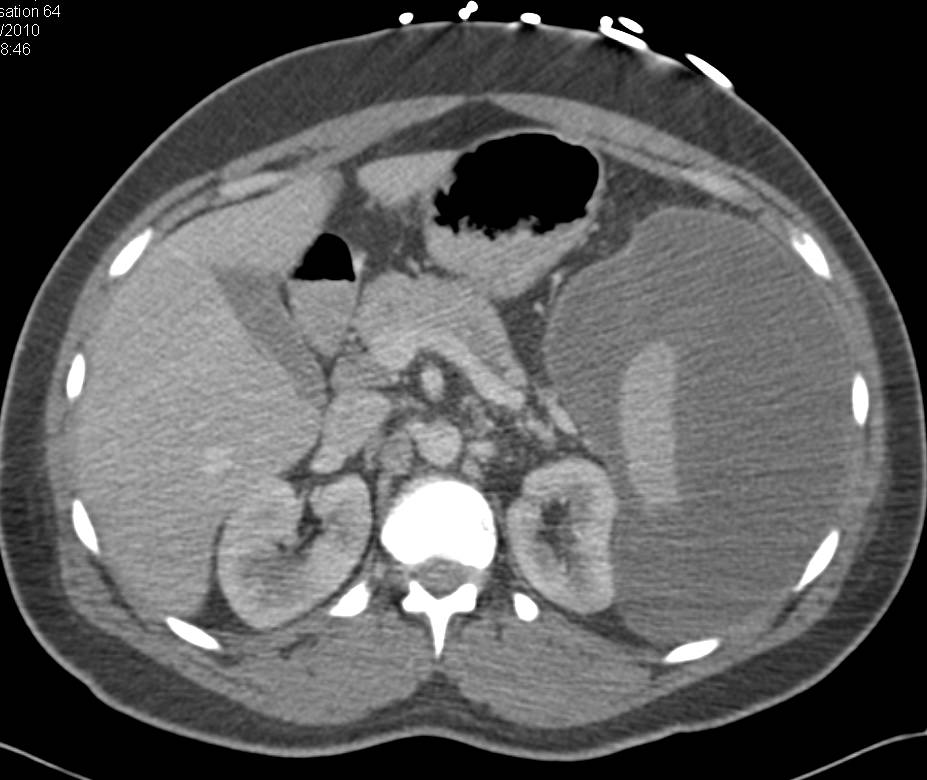 Large Subcapsular Hematoma in the Spleen - CTisus CT Scan