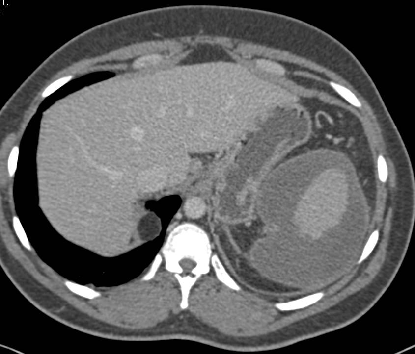 Subcapsular Hematoma in the Spleen - CTisus CT Scan